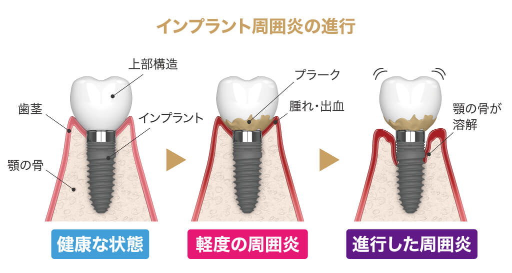 インプラント治療後のメンテナンス